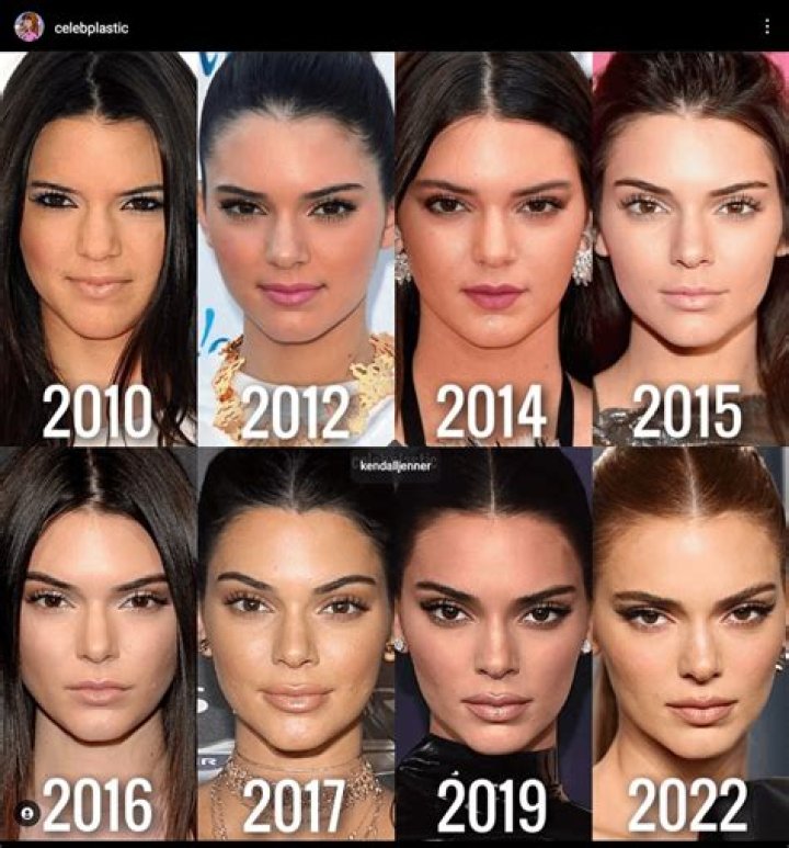 ​Kendall Jenner Dishes About The Change She Made To Her Diet To Eliminate Acne After Years-Long Struggle